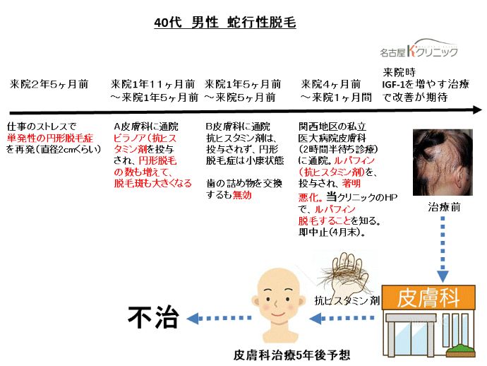 円形脱毛症　病院